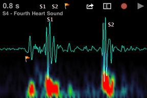 Stethoscope App